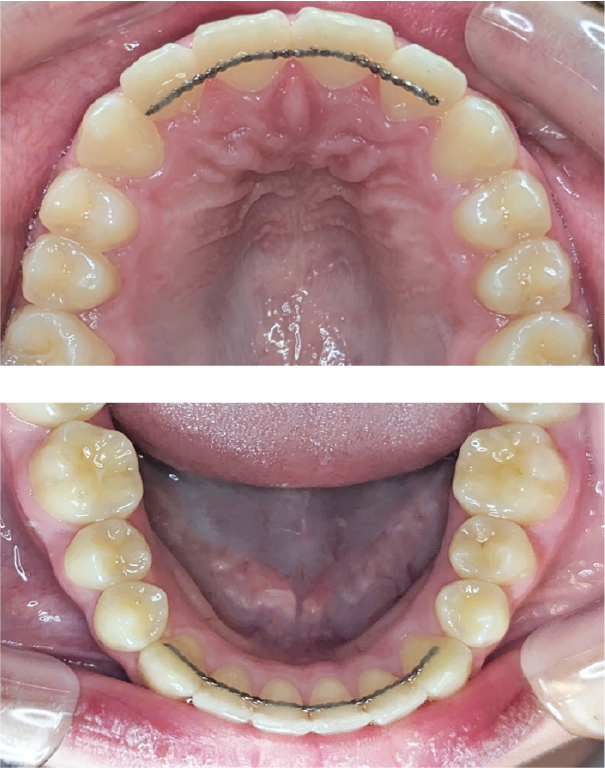 Permanent Retainer | Leber Orthodontics | Tucson Braces