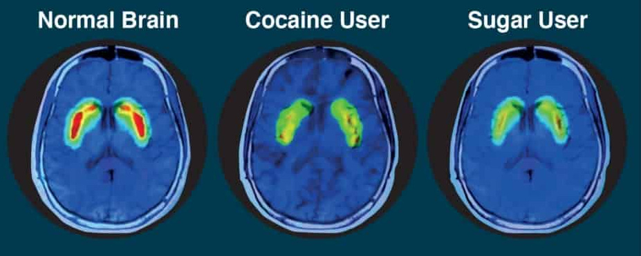 Your Brain on Sugar: What the Science Says - DietCommunity-Community is  Curative