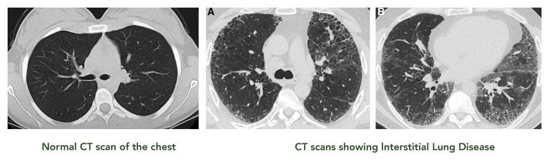 Interstitial Lung Disease (ILD) in Singapore - Dr Akash Verma
