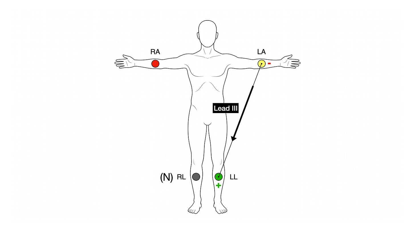 Front-view torso with limb electrodes labelled RA (red), LA (yellow), LL (green), and N RL (black). A black arrow runs diagonally from the LA electrode down to the LL electrode and is labelled Lead III. The LL electrode is marked (+) and the LA electrode (−).