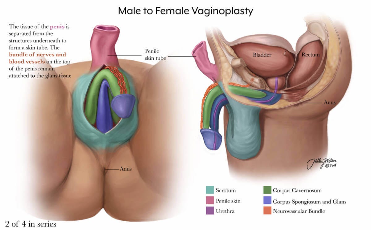 Vaginoplasty for Gender Affirmation | Johns Hopkins Medicine Vaginoplasty for Gender Affirmation | Johns Hopkins Medicine