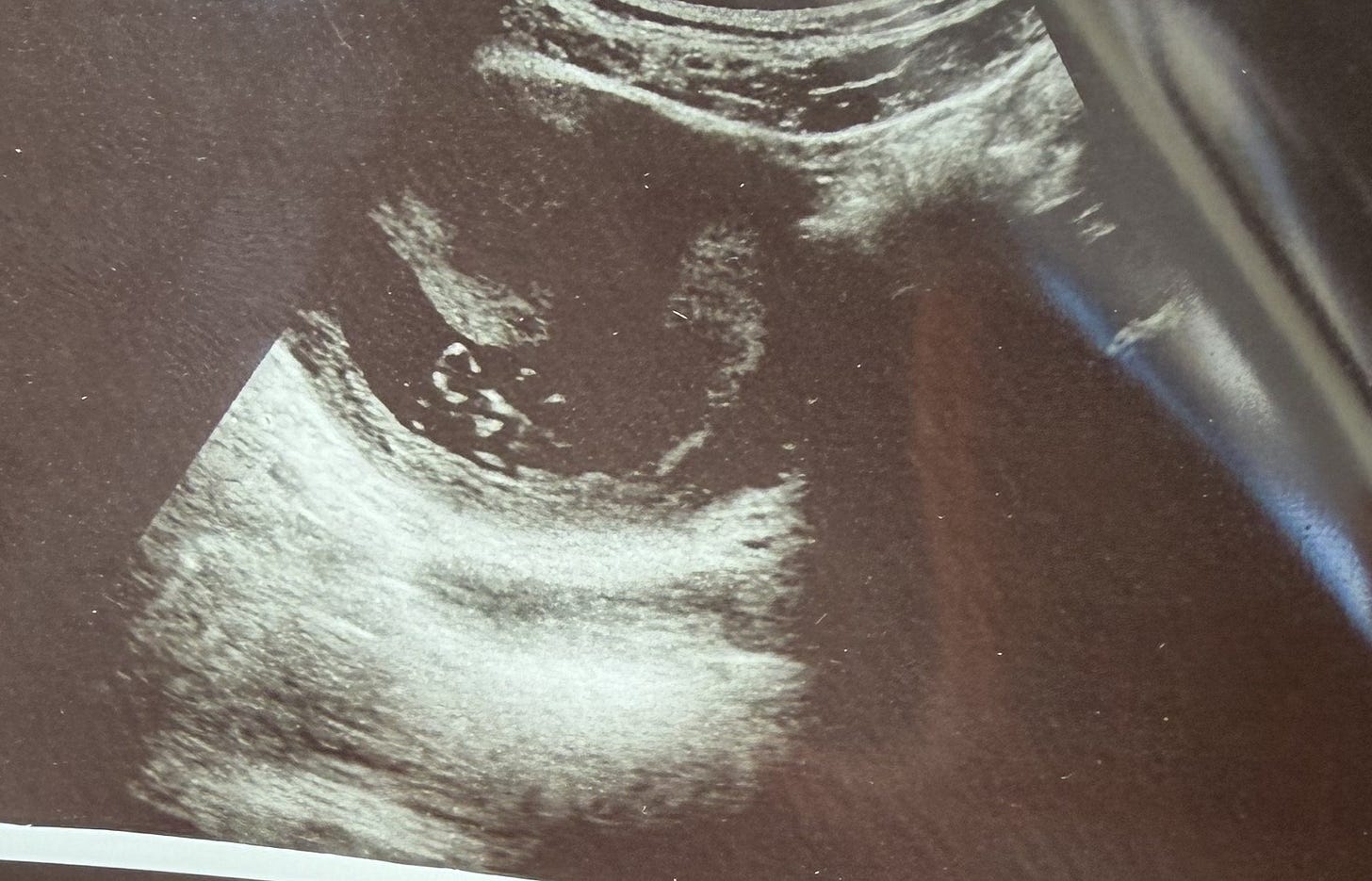 a blurry ultrasound image of the new baby ferraro coming in december 2026
