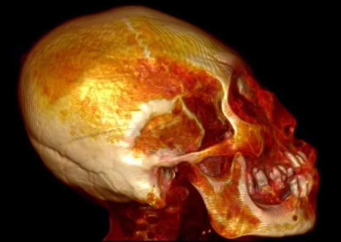 Os cientistas descobriram que a múmia não tinha cabelos e orelhas externas, ou seja, havia apenas aberturas nos canais auditivos. Descobriu-se também que o alongamento do crânio não foi criado artificialmente Os cientistas descobriram que a múmia não tinha cabelos e orelhas externas, ou seja, havia apenas aberturas nos canais auditivos. Descobriu-se também que o alongamento do crânio não foi criado artificialmente