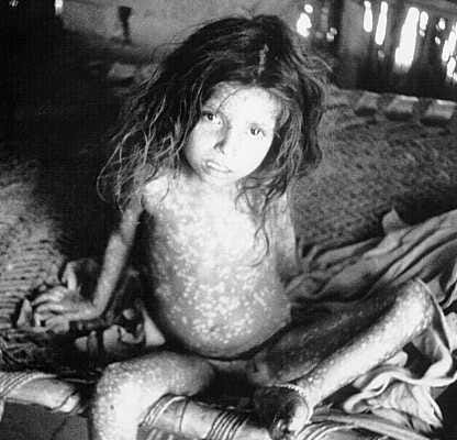 Portrait of a child with smallpox