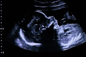 Fetal image in womb