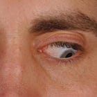 Bombshell Study: COVID Shots Cause a Shocking New Form of EYE & FACE PARALYSIS