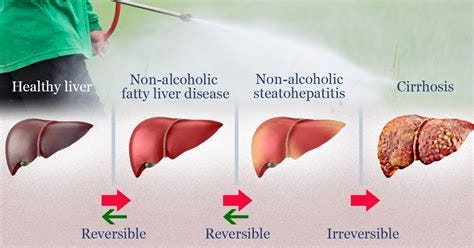 Alcoholic Fatty Liver