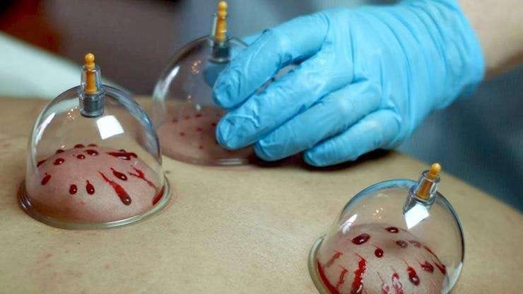 Wet (HIJAMA) Cupping - Holistic Buddha