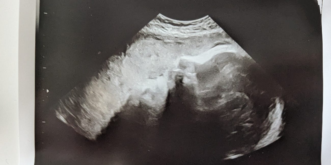 One Hundred Percent (Still) Pregnant