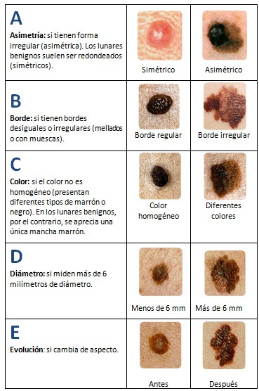 Claves para la detección precoz del melanoma: Sistema ABCDE - Blog de Salud