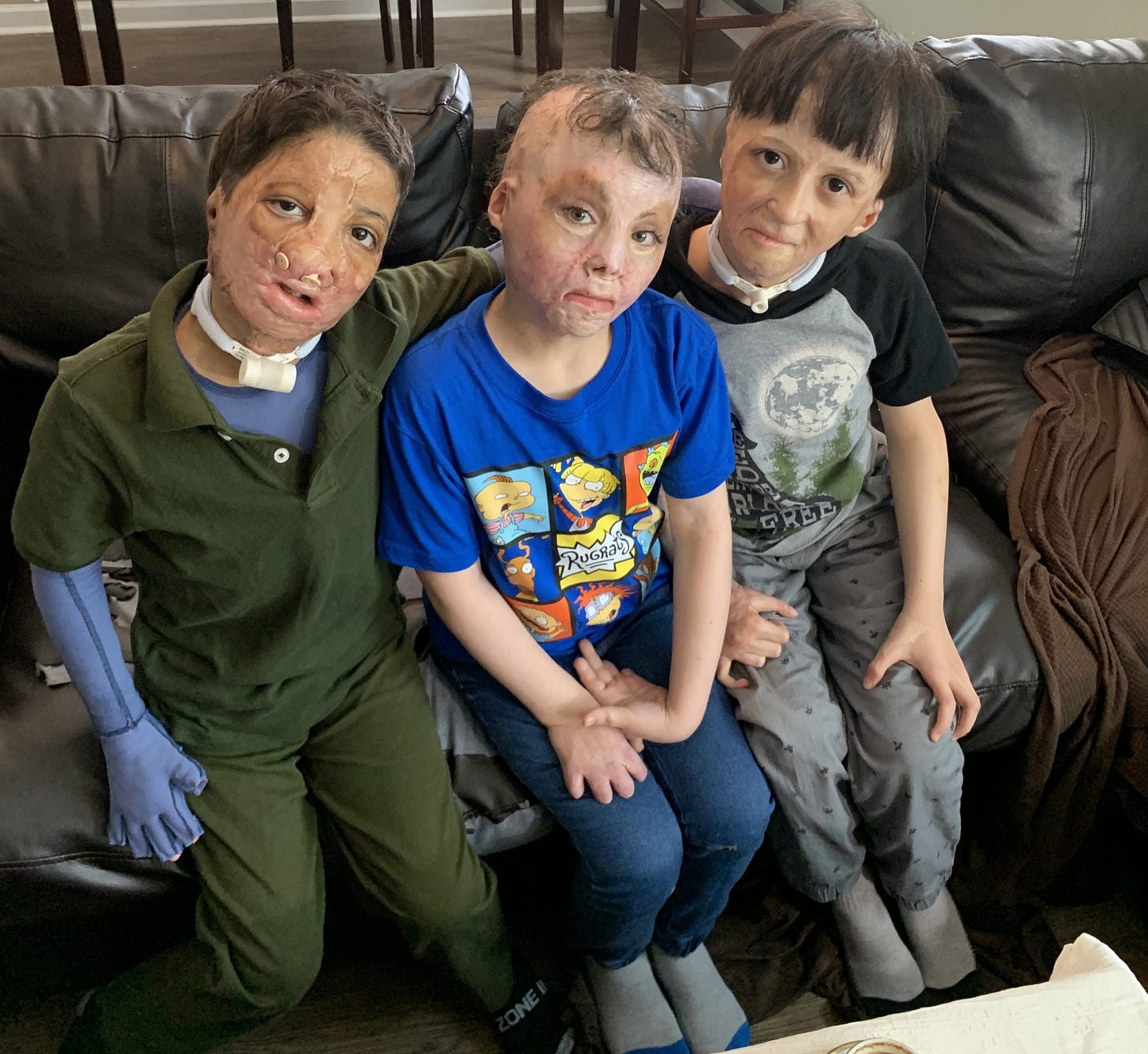 Syrian burned children helped in the US