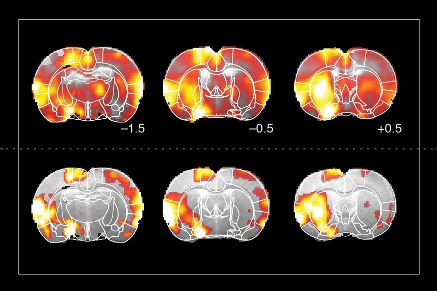 Yellow and red against grey brain fmri imaging