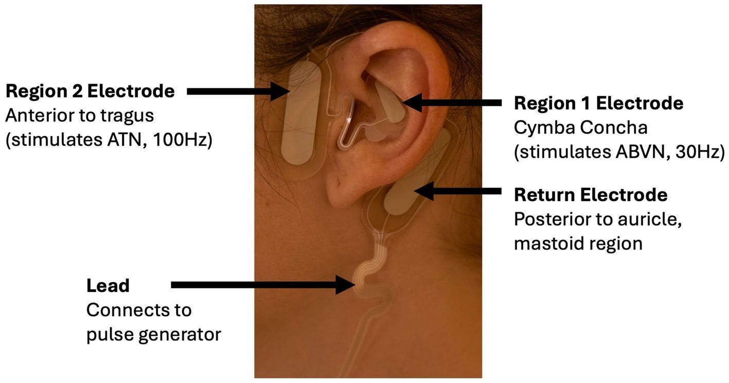 Close-up of a person’s ear with labeled electrodes. The Region 1 electrode is on the cymba concha to stimulate ABVN at 30 Hz. The Region 2 electrode is positioned anterior to the tragus to stimulate ATN at 100 Hz. The return electrode is posterior to the auricle in the mastoid region. A lead connects the electrodes to a pulse generator. Close-up of a person’s ear with labeled electrodes. The Region 1 electrode is on the cymba concha to stimulate ABVN at 30 Hz. The Region 2 electrode is positioned anterior to the tragus to stimulate ATN at 100 Hz. The return electrode is posterior to the auricle in the mastoid region. A lead connects the electrodes to a pulse generator.