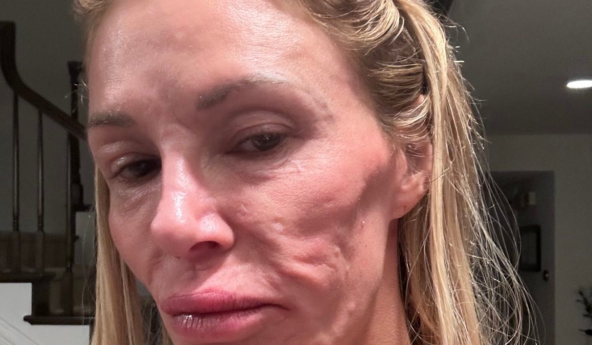 What we can learn from Brandi Glanville's disfigured face