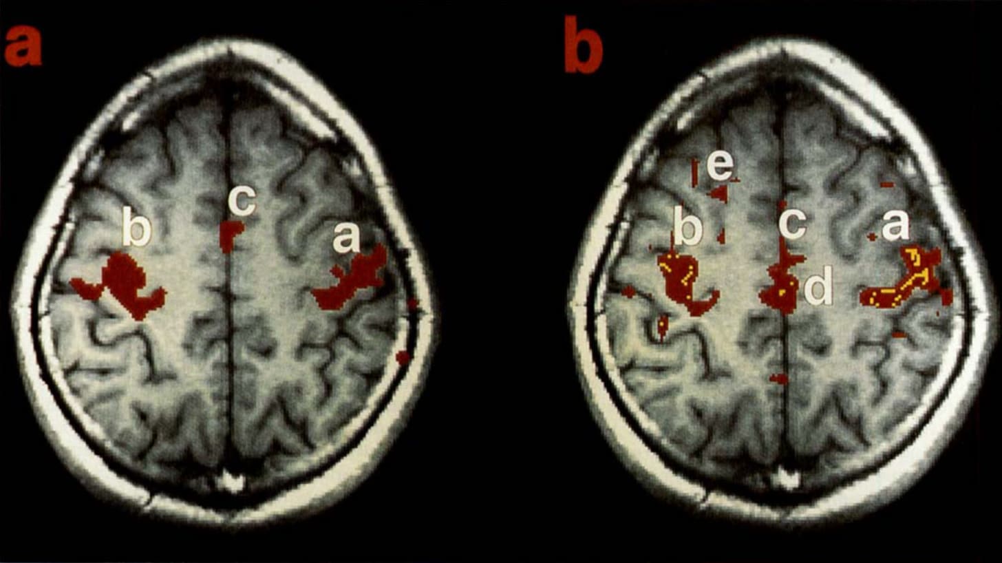 Figure 1. [Biswal et al. (1995)] (a) Finger-tapping task activations for one subject. | (b) Functional connectivity analysis using a central “pixel” in blob “b” showing positive (red) and negative (yellow) correlations.