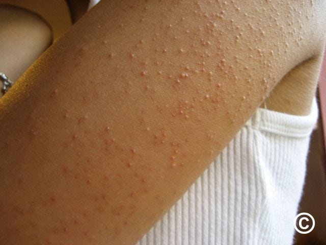 Keratosis pilaris Keratosis pilaris