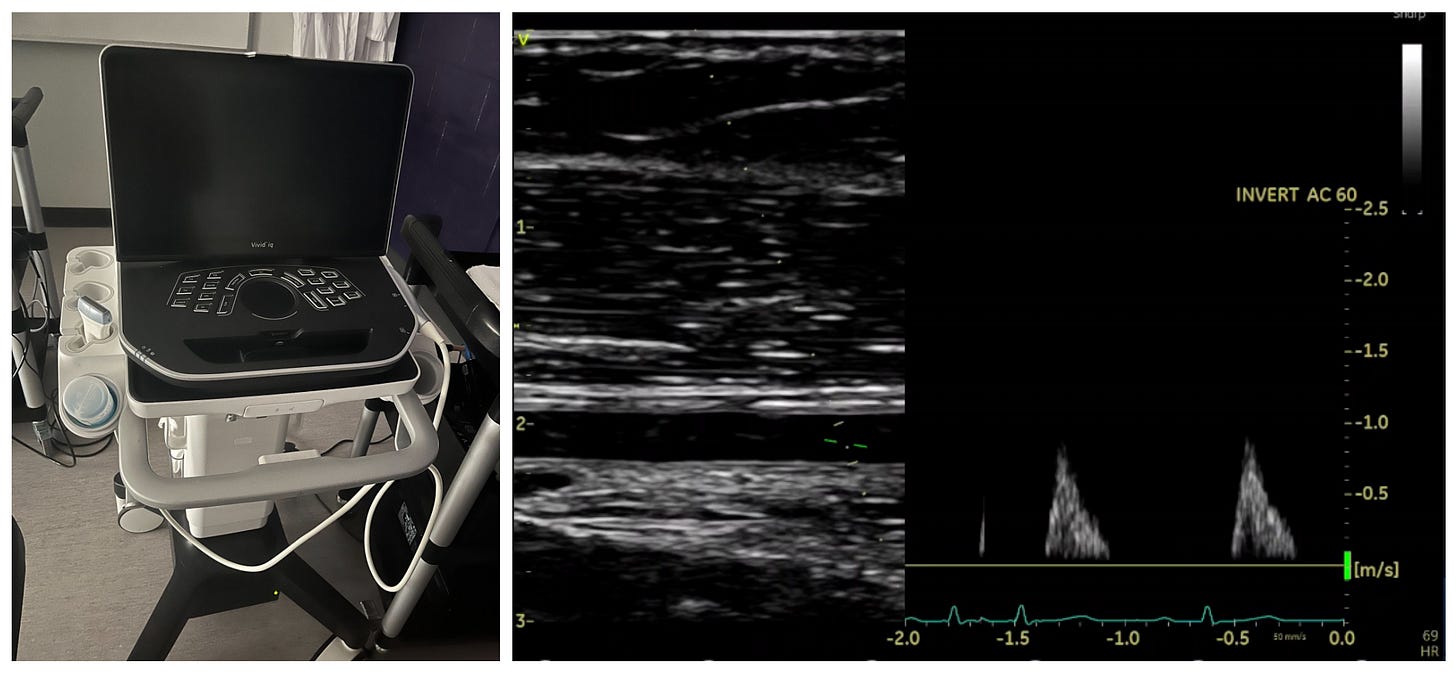In this image, we are using an ultrasound to look at the insight of the arteries - in this case the brachial artery in the arm. We can do a simple test that uses a blood pressure cuff to inflate causing blood flow to slow down; when we release the cuff, blood flow increases and the artery gets bigger. The degree to which it gets better tells us how healthy the artery is. In this image, we are using an ultrasound to look at the insight of the arteries - in this case the brachial artery in the arm. We can do a simple test that uses a blood pressure cuff to inflate causing blood flow to slow down; when we release the cuff, blood flow increases and the artery gets bigger. The degree to which it gets better tells us how healthy the artery is.