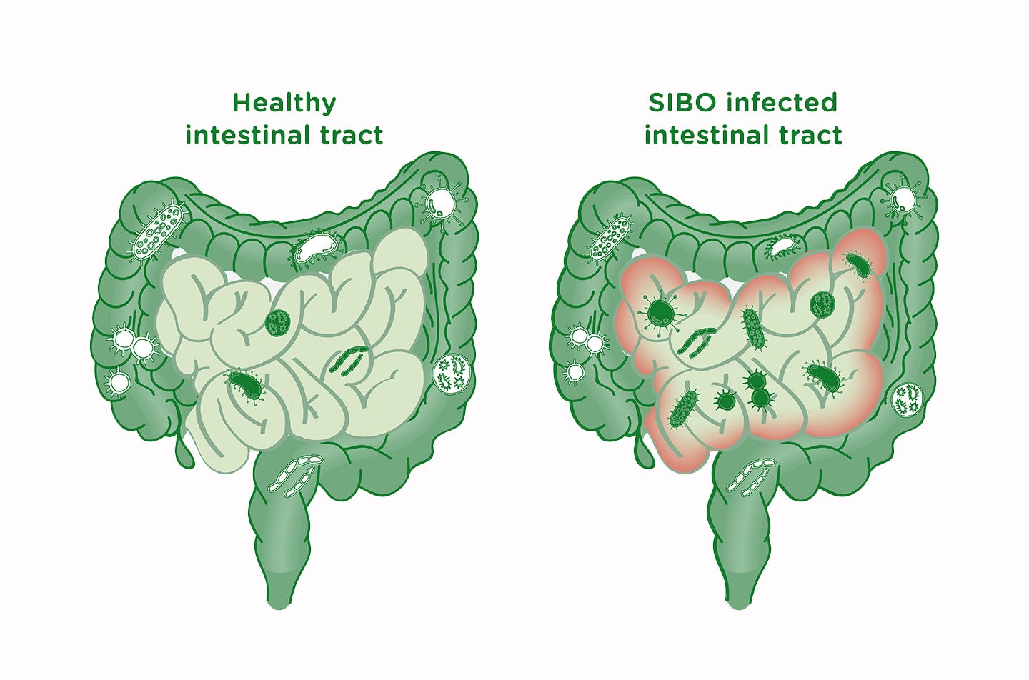 small intestinal bacterial overgrowth