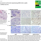 BREAKING: Metastatic Breast Cancer Tumor Found Expressing Spike Protein After Six mRNA Shots