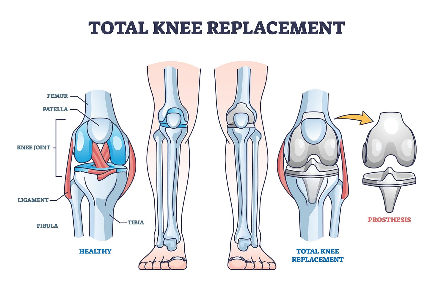 Image of a total knee arthroplasty procedure Image of a total knee arthroplasty procedure