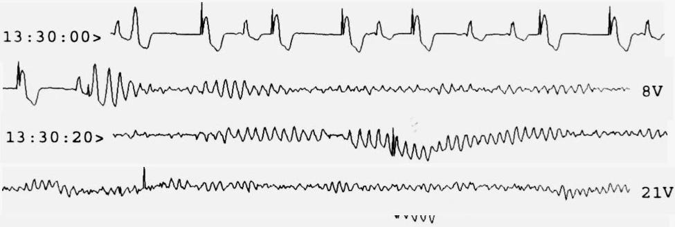 An ECG trace showing sinus rhythm overlaid with pacemaker spikes. The pacemaker is firing asynchronously. In the later part of the strip, a pacing spike at the start of a T wave induces ventricular fibrillation, which persists.