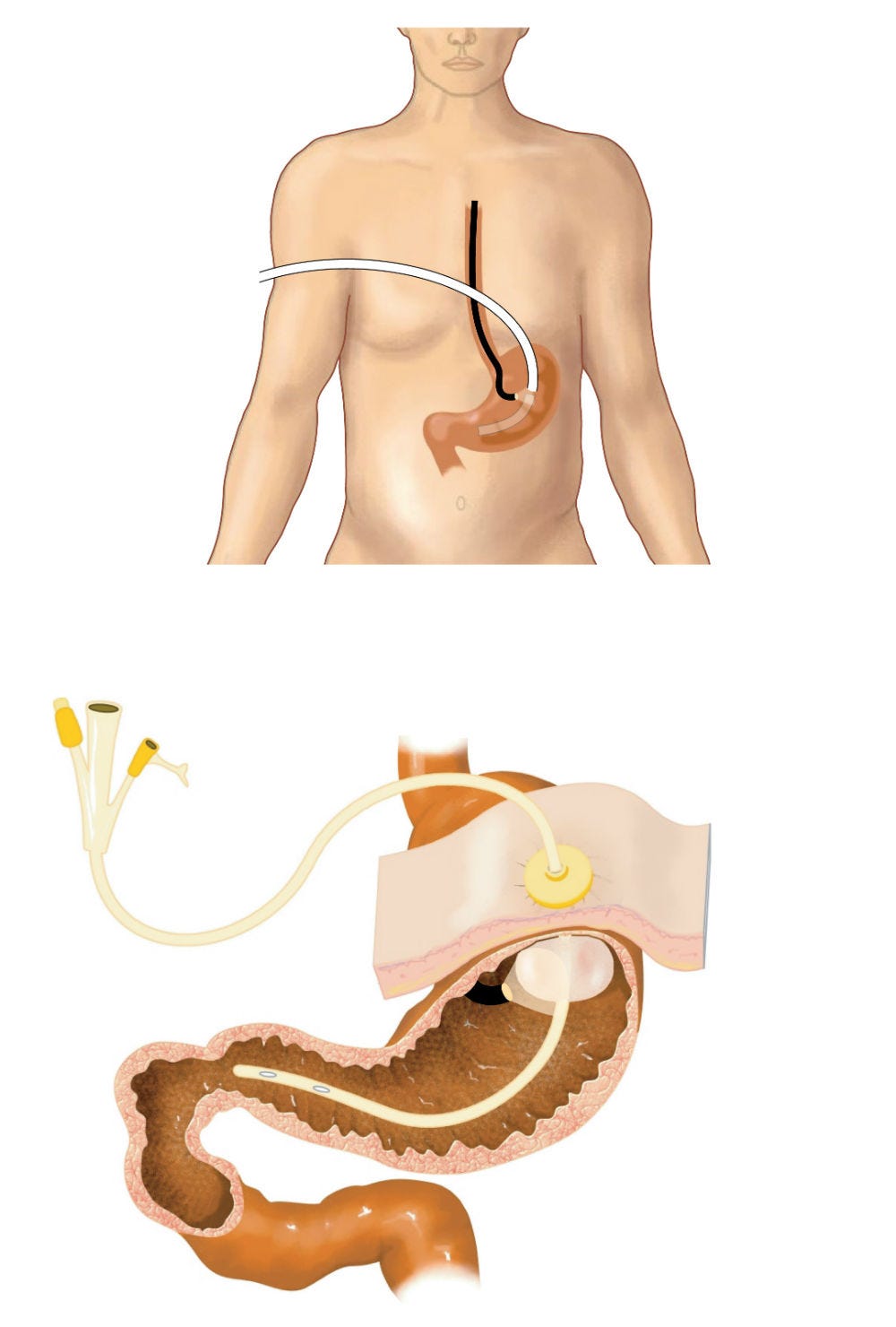 Feeding Tube Placement &amp; Removal | Oregon City &amp; Portland