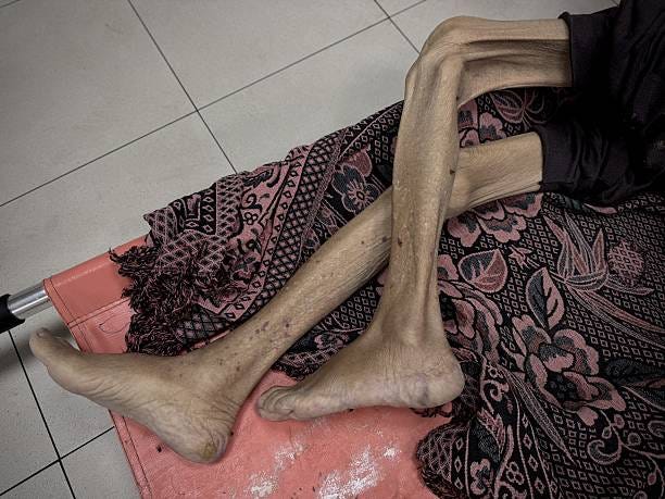 Year-old Gaza man Rabia Abdulkarim Aslih is brought to Nasser Hospital after he dies of malnutrition due to the ongoing hunger crisis caused by...