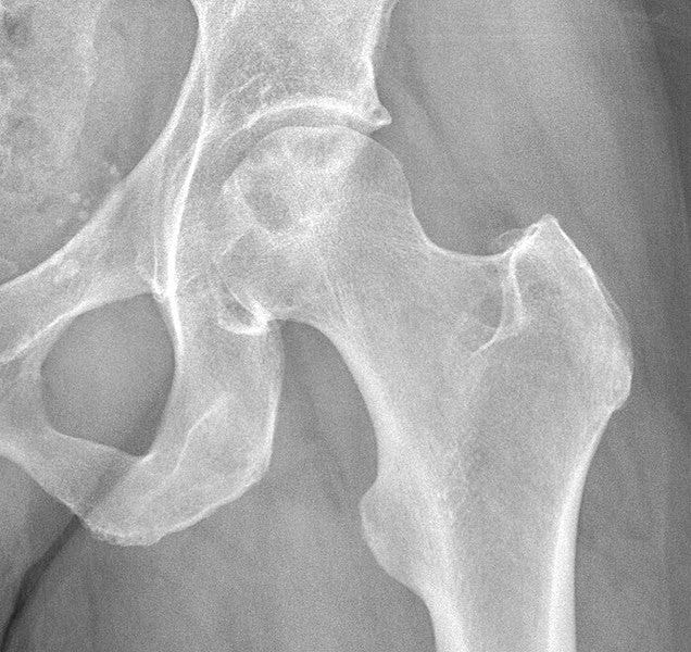 File:X-ray of idiopathic avascular necrosis of the femoral head - Anteroposterior.jpg