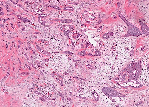 Glands and squamous nests Glands and squamous nests