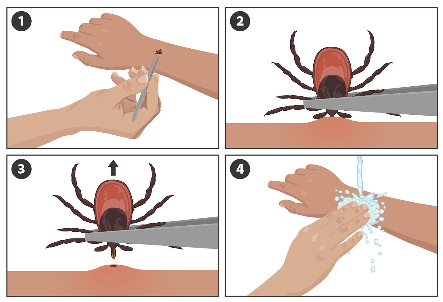 Illustration showing how to remove a tick with tweezers (Ixodes scapularis pictured).