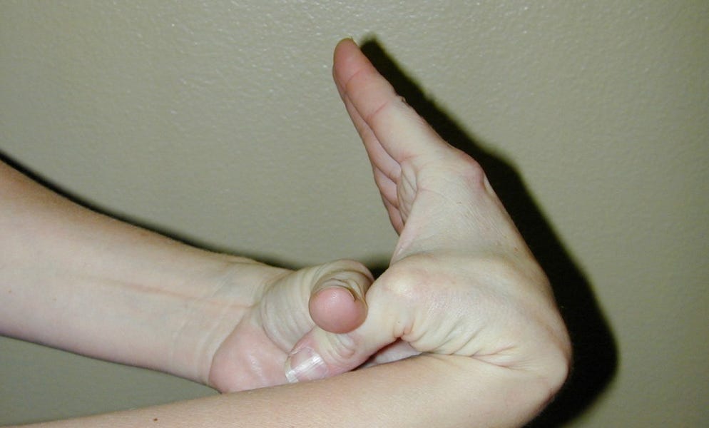 The Hidden Link Between Hypermobility, Vaccine Injury and Fluid Stagnation