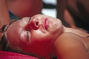 Woman at beach with sunburned face
