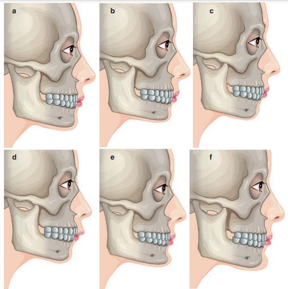 Perfiloplastia, harmonização facial