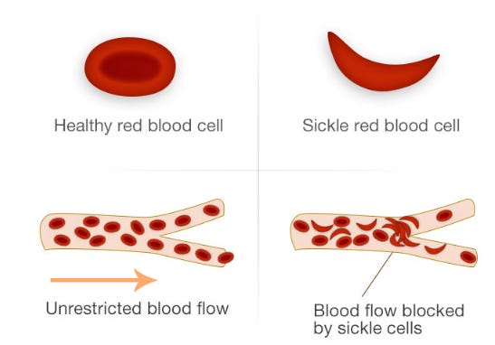 Sickle Cell Disease – TIF