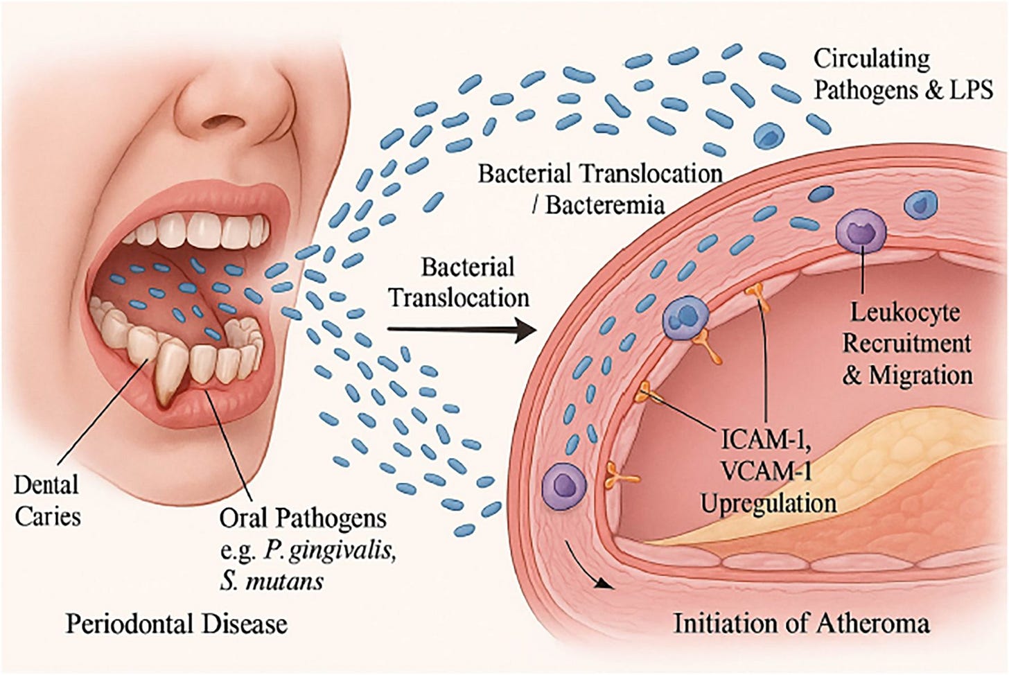 Frontiers | The oral microbiome and atherosclerosis: current evidence on  association, mechanisms, and clinical implications