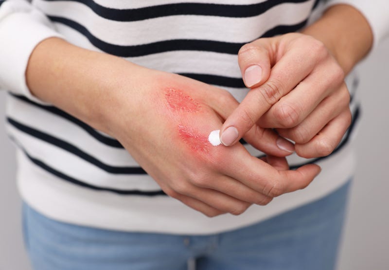 External Wound Healing External Wound Healing