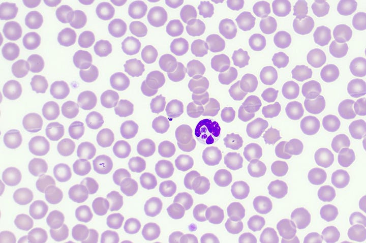 Anaplasma phagocytophilum morulae in neutrophils of dogs and cats on a peripheral blood smear northeast USA