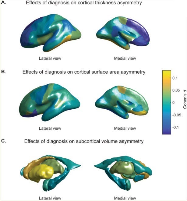 Are Autistic Brains Different From Neurotypical Brains?