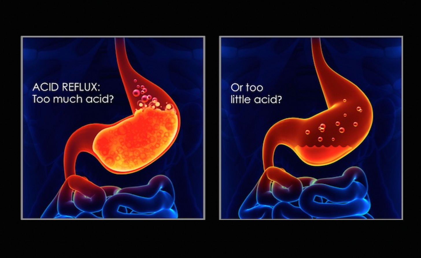 Stomach Acid Is Good For You - by A Midwestern Doctor Stomach Acid Is Good For You - by A Midwestern Doctor