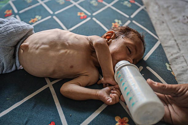 Five-month-old Palestinian infant Abdulkarim Sobh is severely malnourished, surviving on only water as his mother is unable to access milk or food...