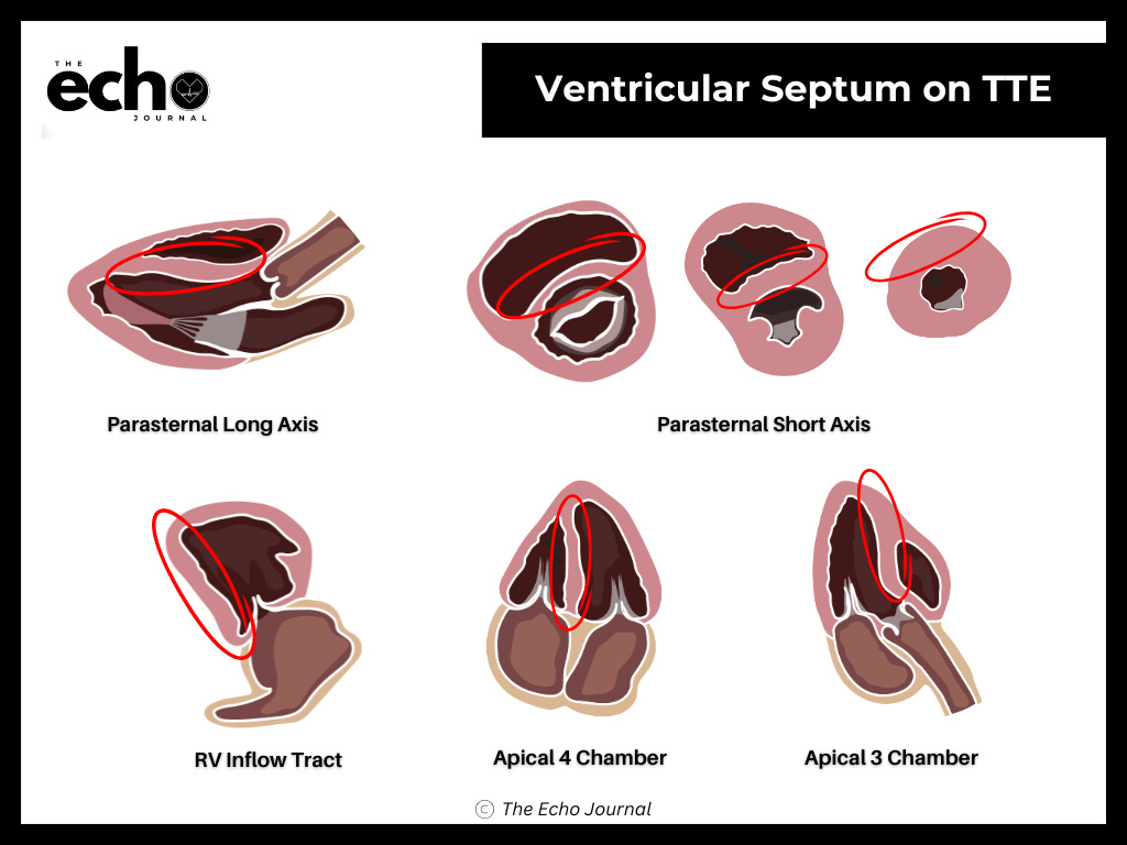 Ventricular Septal Rupture: The Echo That Changes Everything