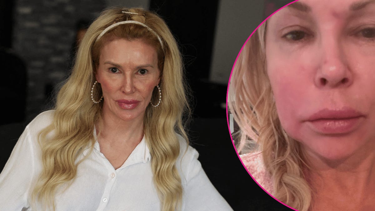 Image of Brandi Glanville shared that she has a benign tumor after finding out her facial parasite is back. Image of Brandi Glanville shared that she has a benign tumor after finding out her facial parasite is back.