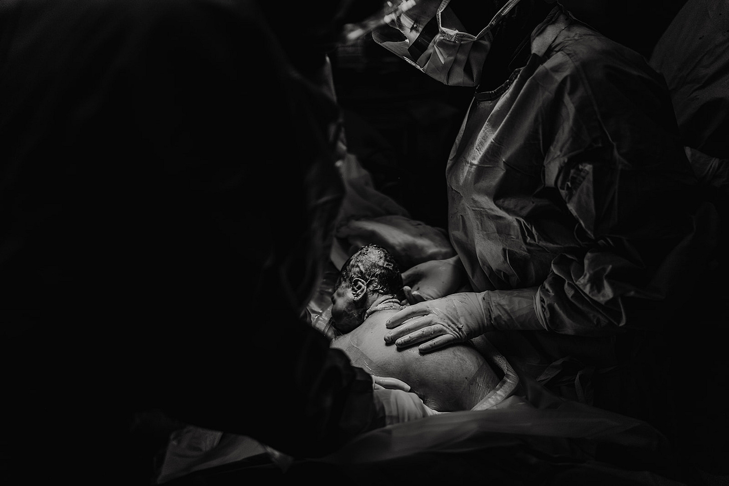 Black and white photograph showing a baby being born by caesarean, showing the moment their head emerges during surgery.