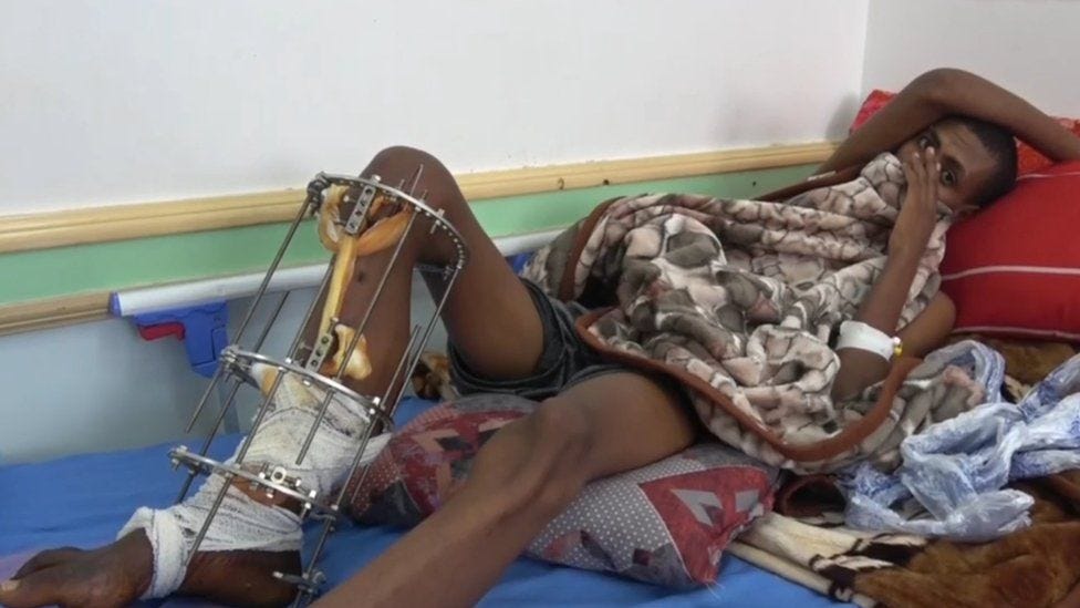 A migrant with an injured leg lies on a hospital bed in the Yemeni city of Saada A migrant with an injured leg lies on a hospital bed in the Yemeni city of Saada