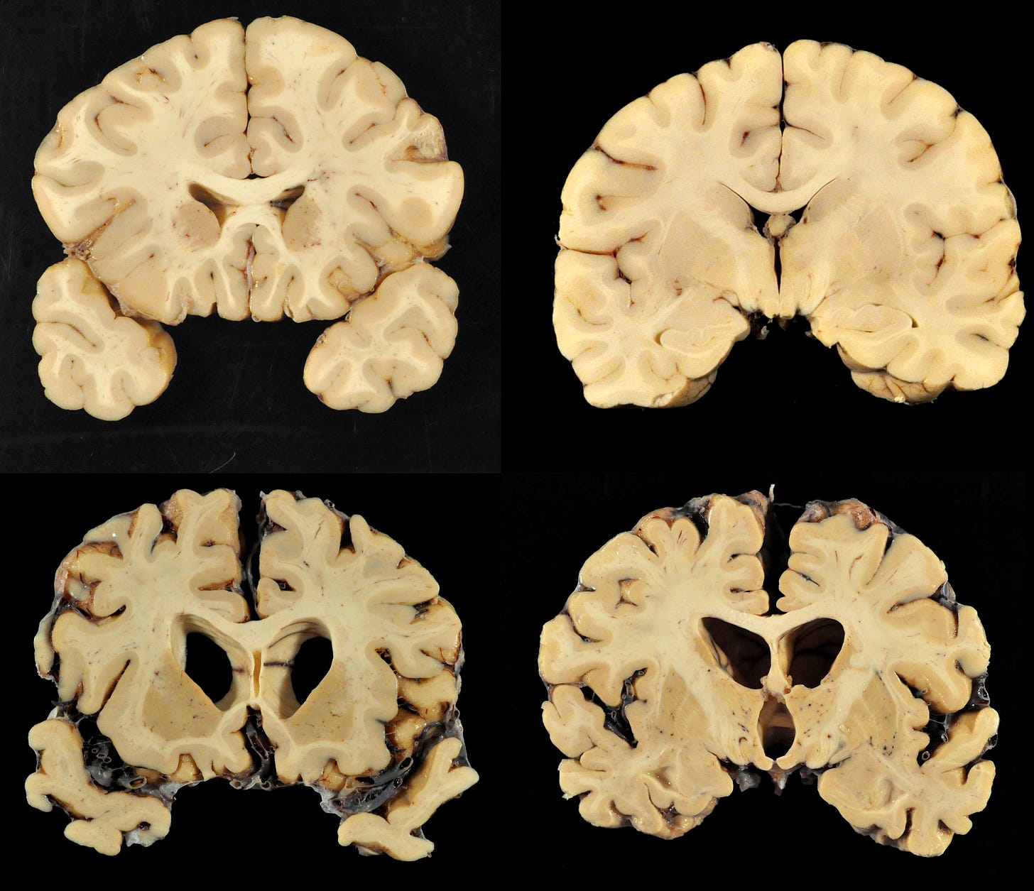 CTE Study Finds Evidence of Brain Disease in 110 Out of 111 Former NFL  Players
