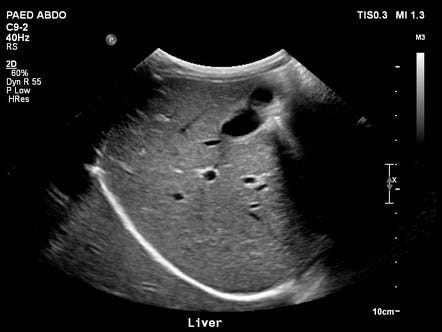 Normal hepatobiliary imaging examples | Radiology Reference Article | Radiopaedia.org