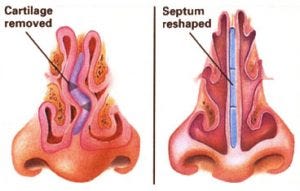 Septoplasty-1