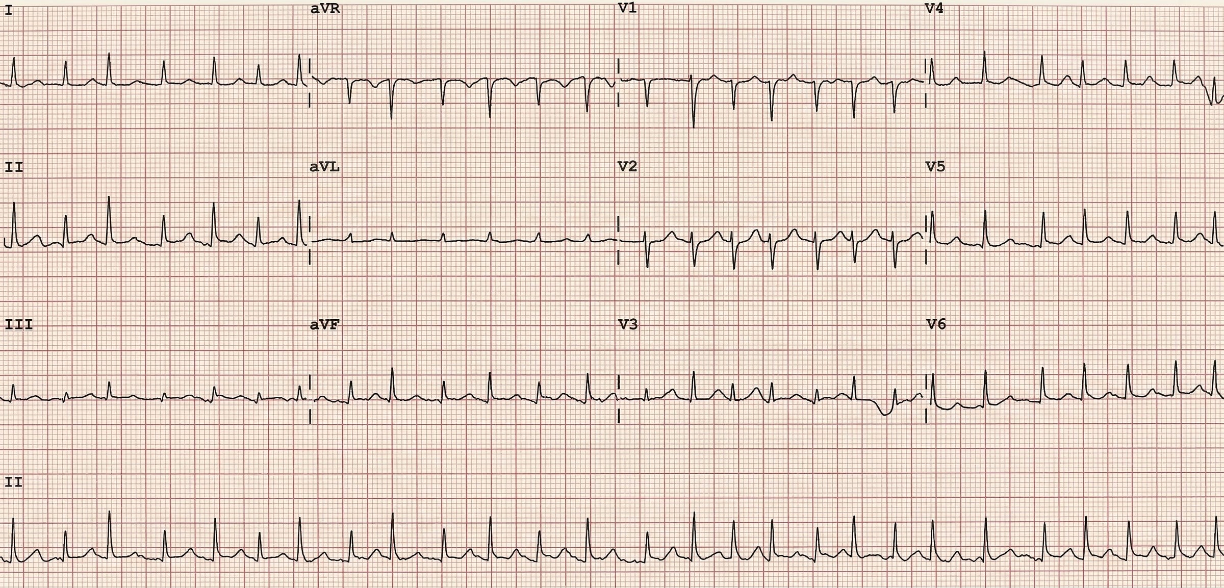 12-lead ECG showing electrical alternans — alternating QRS amplitude, irregular rhythm, no P waves, low voltage, tachycardia