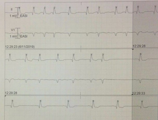 pill in pocket flecainide