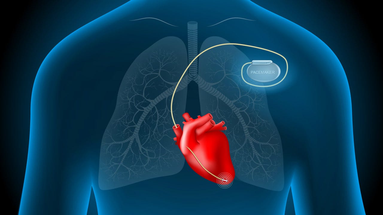 Cardiac Pacemaker | Fact Sheets | Yale Medicine